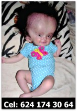 2 caso de hidrocefalia cabo san lucas