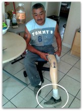 2 - 1 protesis dañada