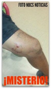 0 a balazo en una pierna